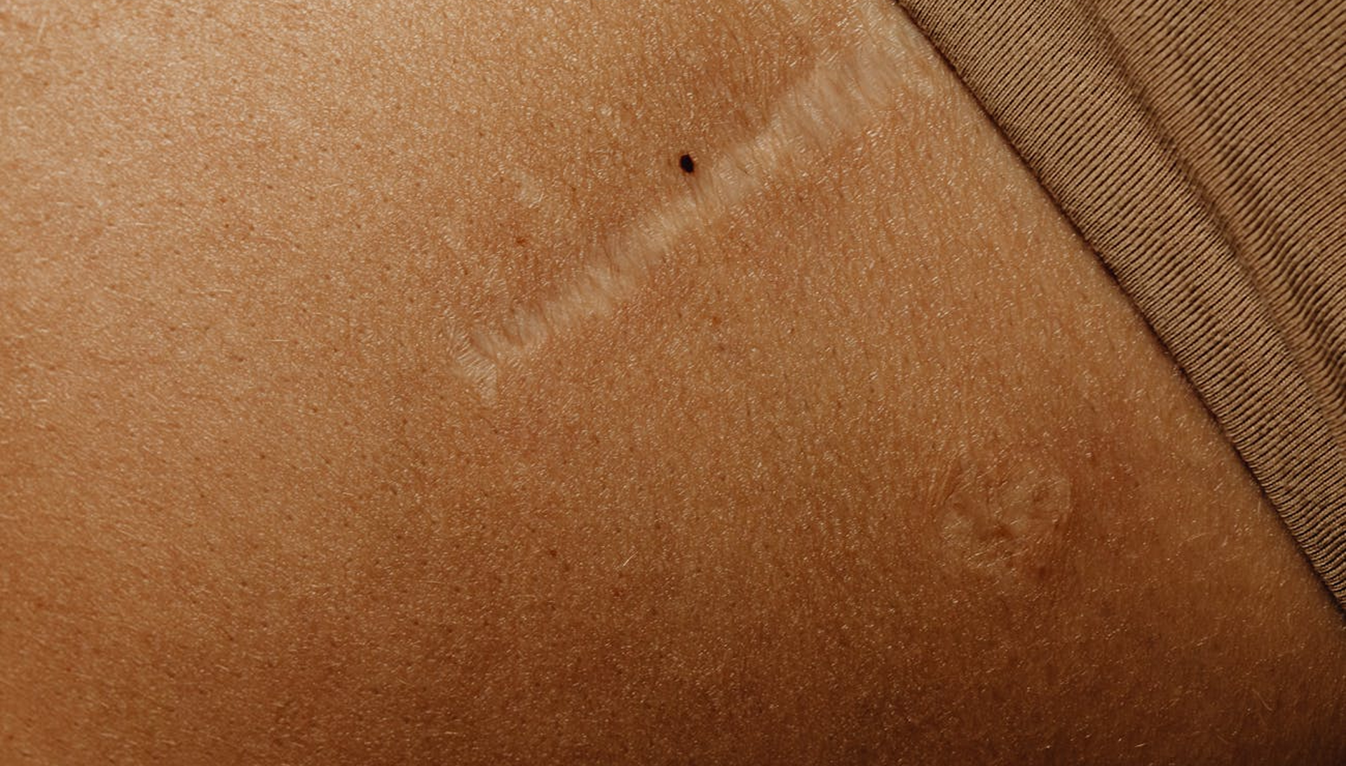 Scar Tissue is Weak Tissue. Recovery Doesn’t Have to Be.